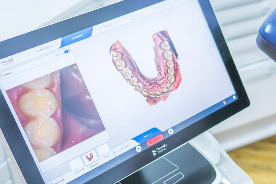Veneers für ästhetische Frontzähne in Köln