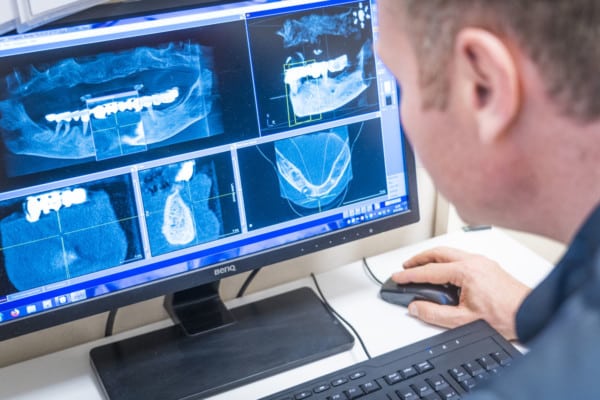 Auswertung einer DVT Aufnahme für die Implantatplanung in Köln