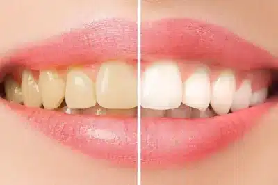 Bleaching für strahlend weiße Zähne in Köln